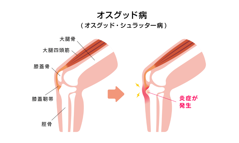 オスグッド病の解剖イラスト