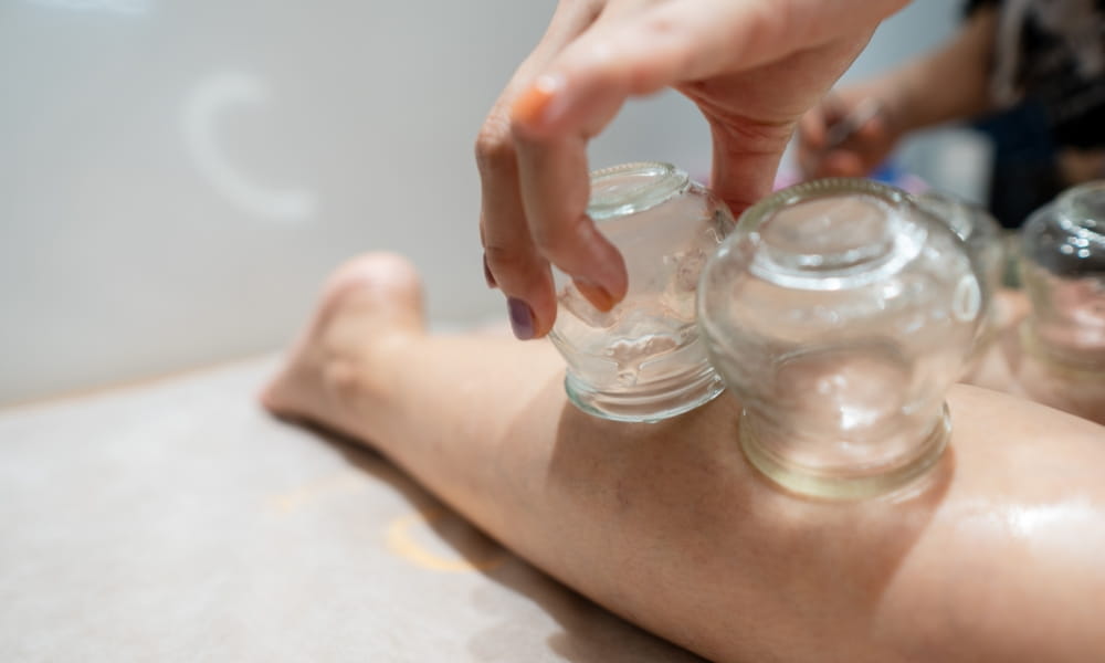 カッピング治療