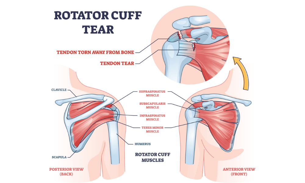 腱板損傷の画像