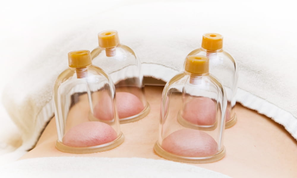 カッピングで皮膚が盛り上がっている状態