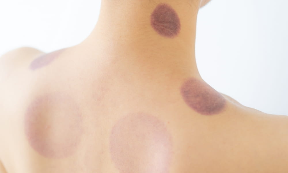 カッピングの肌の跡